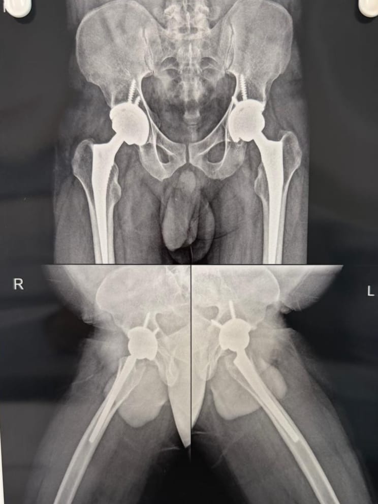 Bilateral direct anterior hip replacement