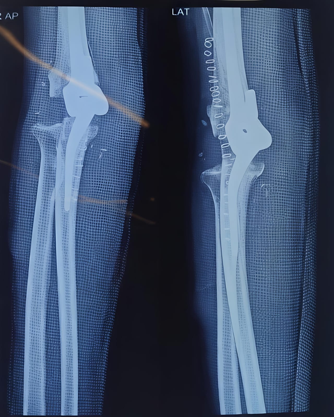 Total elbow arthroplasty