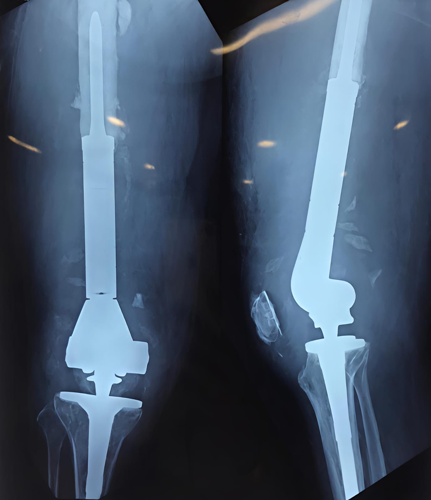 Megaprosthesis reconstruction